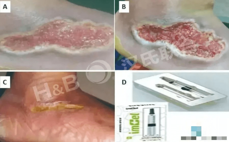 糖尿病足潰瘍患者使用胎盤(pán)衍生間充質(zhì)干細胞水凝膠進(jìn)行三周局部治療：病例報告。
