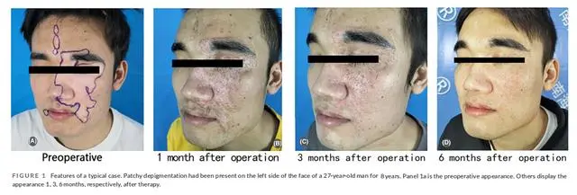 2023年干細胞治療白癜風(fēng)臨床案例