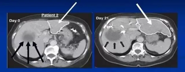 干細胞治療肝硬化的治療效果如何？