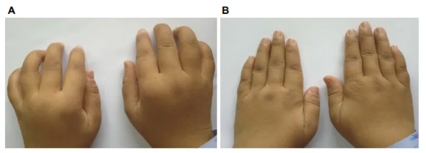 33歲女性，患病4年，治療前后對比