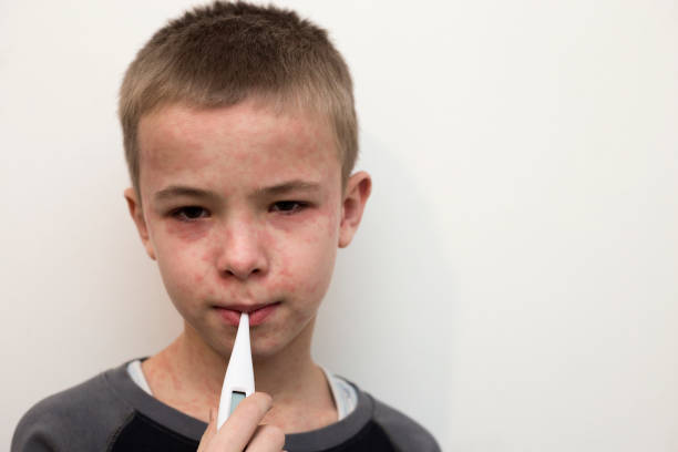 兒童狼瘡性腎炎-癥狀、原因和治療方法