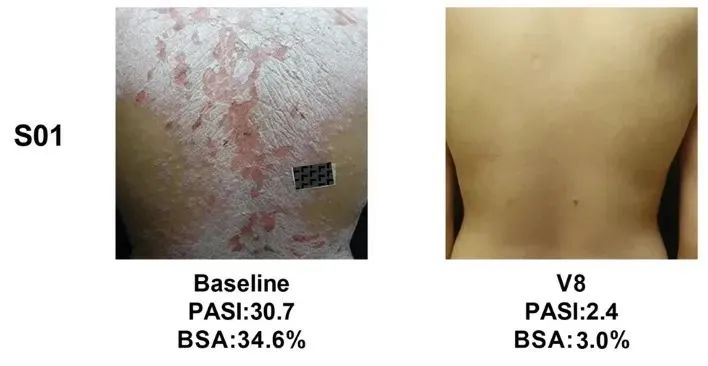 同種異體UMSCs的移植對銀屑病患者安全且部分有效，尤其對女性銀屑病患者