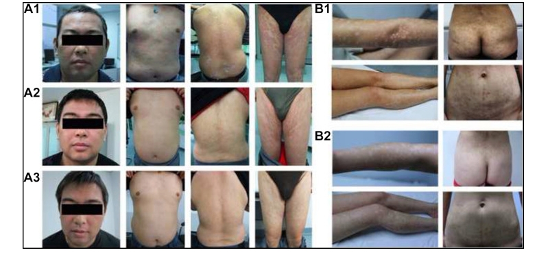 兩例尋常型銀屑病患者通過(guò)臍帶間充質(zhì)干細胞（UC-MSCs）治療，兩例患者均在4至5年內未復發(fā)。