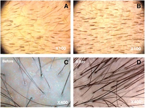 圖3：記錄脂肪干細胞療法后頭發(fā)數量增加的照片。移植前（ac）和移植后6個(gè)月（bd）頭皮的代表性圖像
