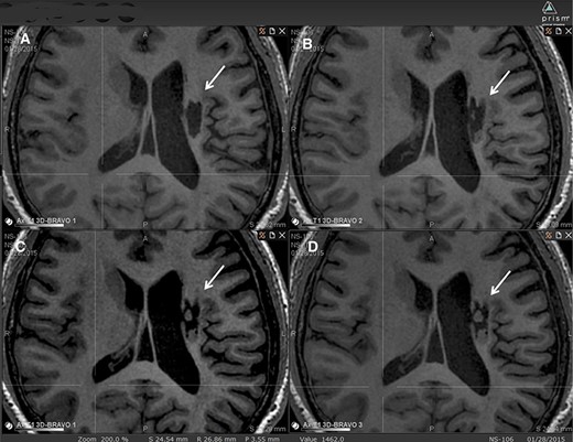 圖2：腔內組織生長(cháng)的縱向MRI示例。
