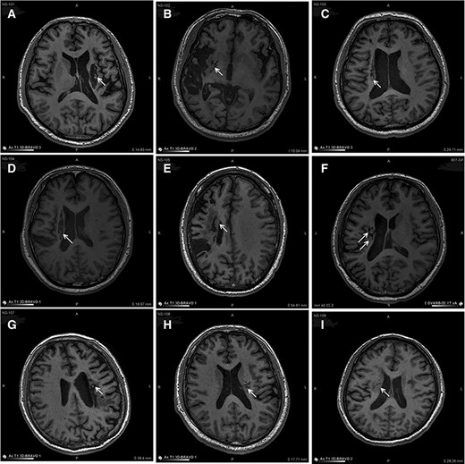 圖3：NSI-566移植后最新隨訪(fǎng)時(shí)梗塞部位的MRI。