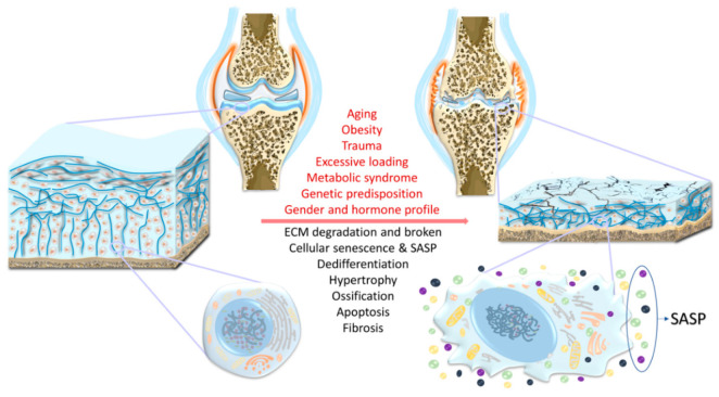 圖1：骨關(guān)節炎（OA）的風(fēng)險因素、結構改變和軟骨細胞特異性變化。