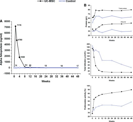 UC-MSC 輸血改善了一名急性慢性肝衰竭患者的血清 α-胎蛋白 (α-FP) 水平。