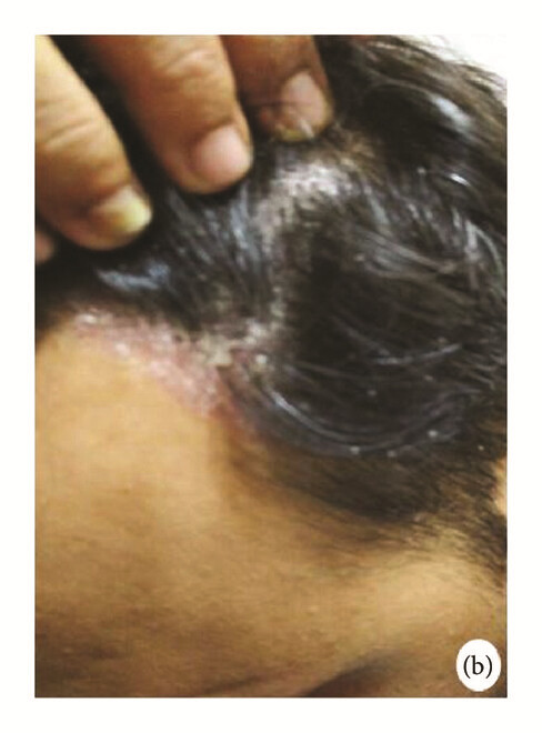 骨髓間充質(zhì)干細胞 治療前，患者頭皮上出現大量紅斑，并附著(zhù)銀色鱗片（b）。