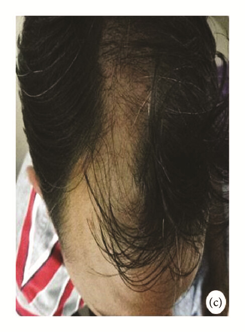 局部應用骨髓間充質(zhì)干細胞一個(gè)月后，銀屑病消退，炎性紅斑完全清除（c）。