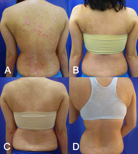 (圖2A）基線(xiàn)（細胞移植前)；(圖2B）首次輸注后 30 天；(圖C2) 121 天后；(圖2D）231 天后。