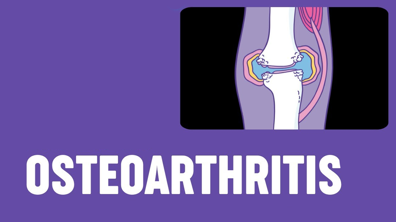 5項研究171例患者，評估干細胞治療骨關(guān)節炎的安全性和有效性