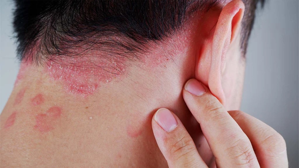 銀屑病如何治療？干細胞療法如何為銀屑病患者掃除障礙？