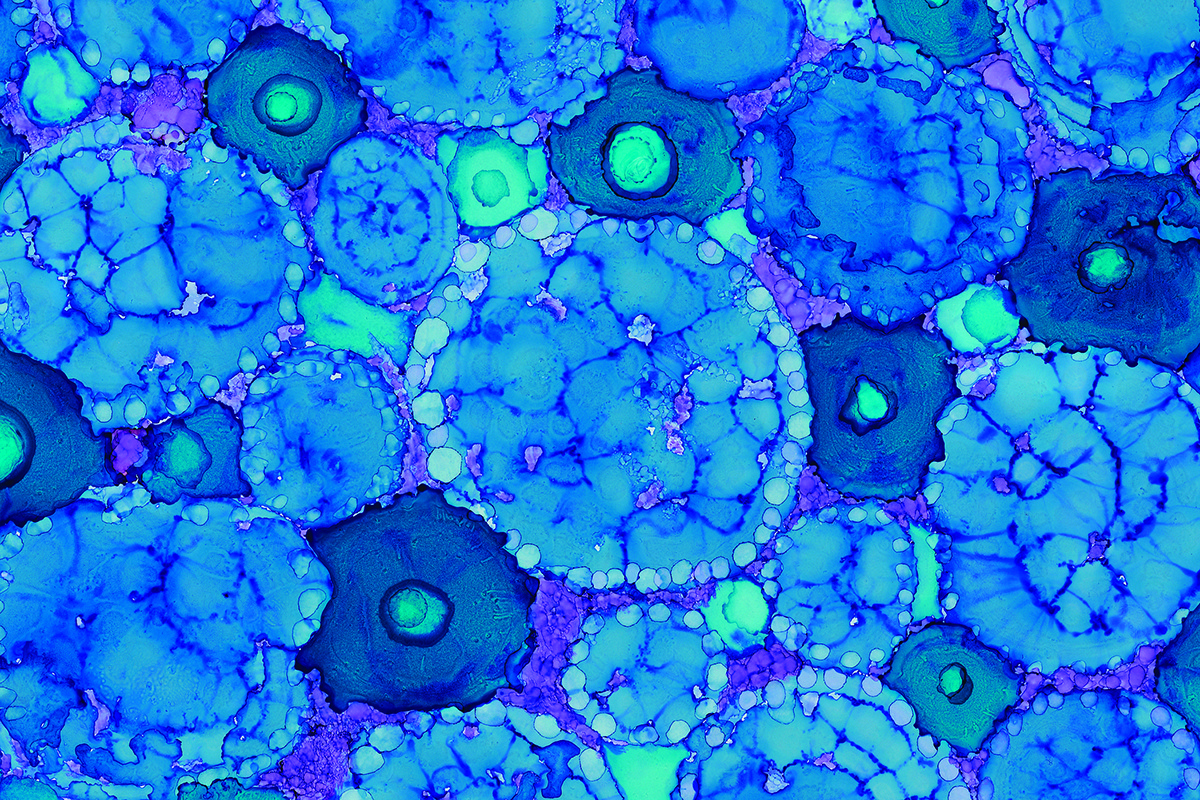 歷年來(lái)Vertex的干細胞治療1型糖尿病的研究進(jìn)展