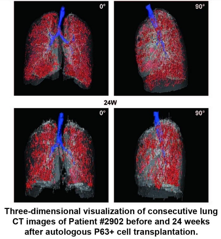 患者#2902在自體P63+細胞移植前后24周連續肺部CT圖像的三維可視化。