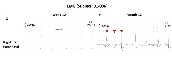 圖3：患者2腦運動(dòng)控制評估(BMCA)和EMG評估