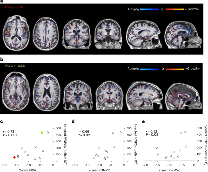 圖5：注射的神經(jīng)干細胞數量與腦容量損失呈反比