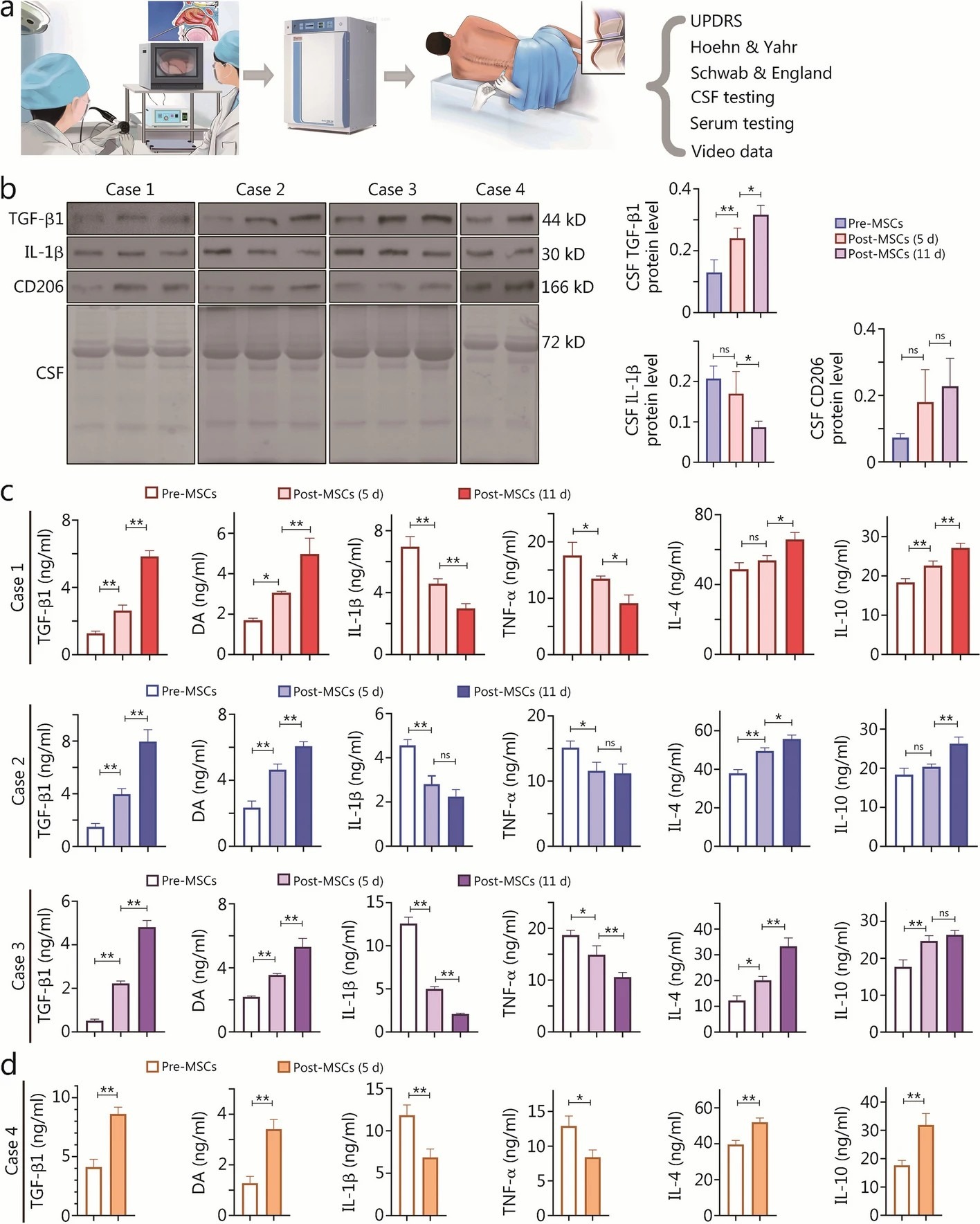 帕金森病患者 I 期 hOM-MSC 植入臨床試驗