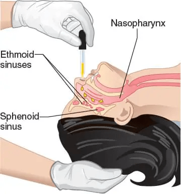 干細胞輸送方法有13種，其中干細胞移植的過(guò)程都是什么樣的？