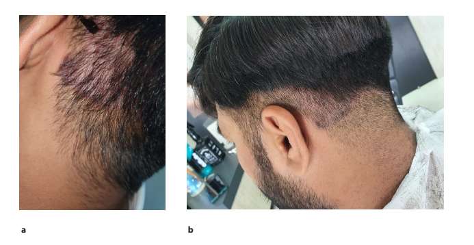 圖2.患者枕部頭皮銀屑病治療后圖像2周(a)和4周(b)頭皮銀屑病治療后鱗屑和斑塊減少的隨訪(fǎng)圖像。