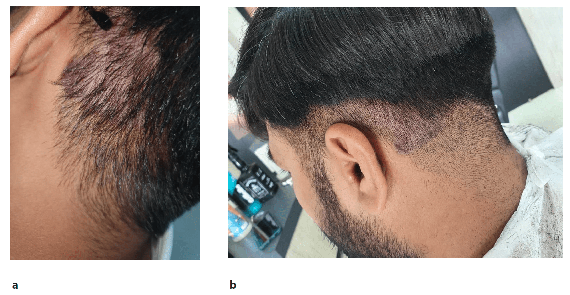 圖2：患者頸部枕部下方頭皮牛皮癬治療后圖像，治療后2周（a）和4周（b）隨訪(fǎng)時(shí)頭皮牛皮癬銀色鱗片和斑塊減少
