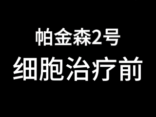 干細胞治療帕金森患者 干細胞治療帕金森患者
