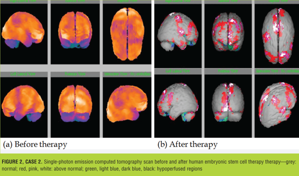 在大腦和小腦區域觀(guān)察到的灌注程度顯著(zhù)降低（圖 2）