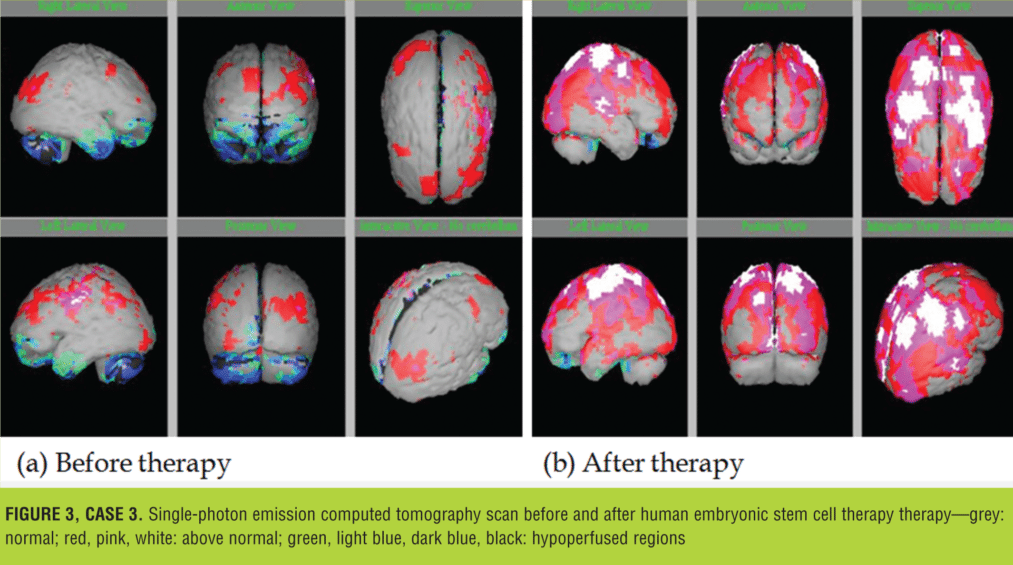 與之前的掃描結果相比，2014 年 1 月 9 日的 SPECT 掃描顯示腦灌注流正常（圖 3）