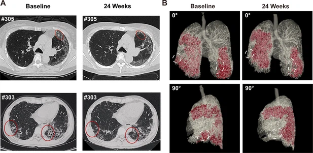 圖4：REGEND001治療前后的代表性肺部CT圖像。