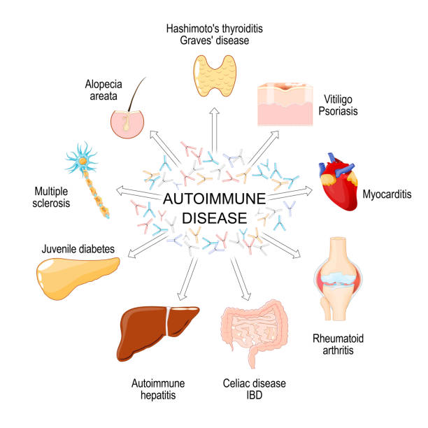 間充質(zhì)干細胞療法：一種在10種自身免疫性疾病中有前景的治療方法