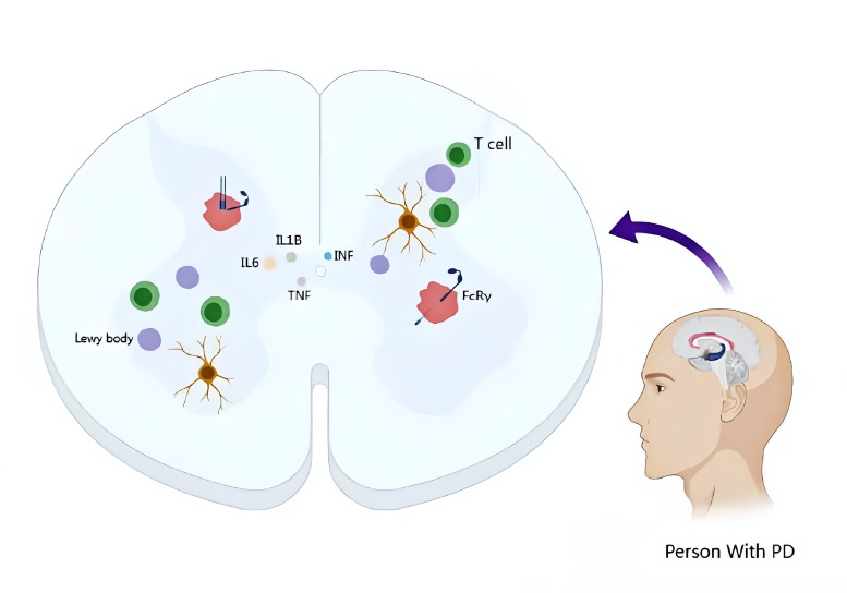 圖1：帕金森病的病理特征和神經(jīng)炎癥的作用