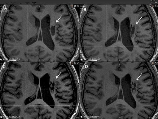 腔內組織生長(cháng)的縱向 MRI 示例 腔內組織生長(cháng)的縱向 MRI 示例