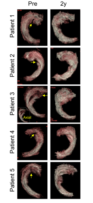 移植滑膜間充質(zhì)干細胞修復前后的3D MRI圖像