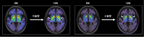 
低劑量和高劑量TED-A9植入一年后的腦成像。