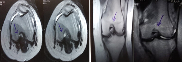 治療前 MRI 顯示內側和外側半月板后角 III 級撕裂。