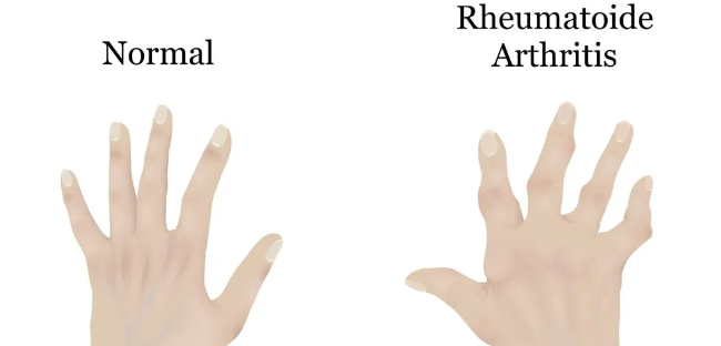 干細胞治療類(lèi)風(fēng)濕關(guān)節炎：如何實(shí)現從短期關(guān)節功能改善到長(cháng)期的生活質(zhì)量提升？
