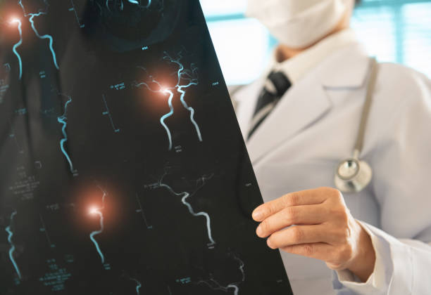 骨髓干細胞治療缺血性卒中靠譜嗎？網(wǎng)絡(luò )薈萃分析給出答案