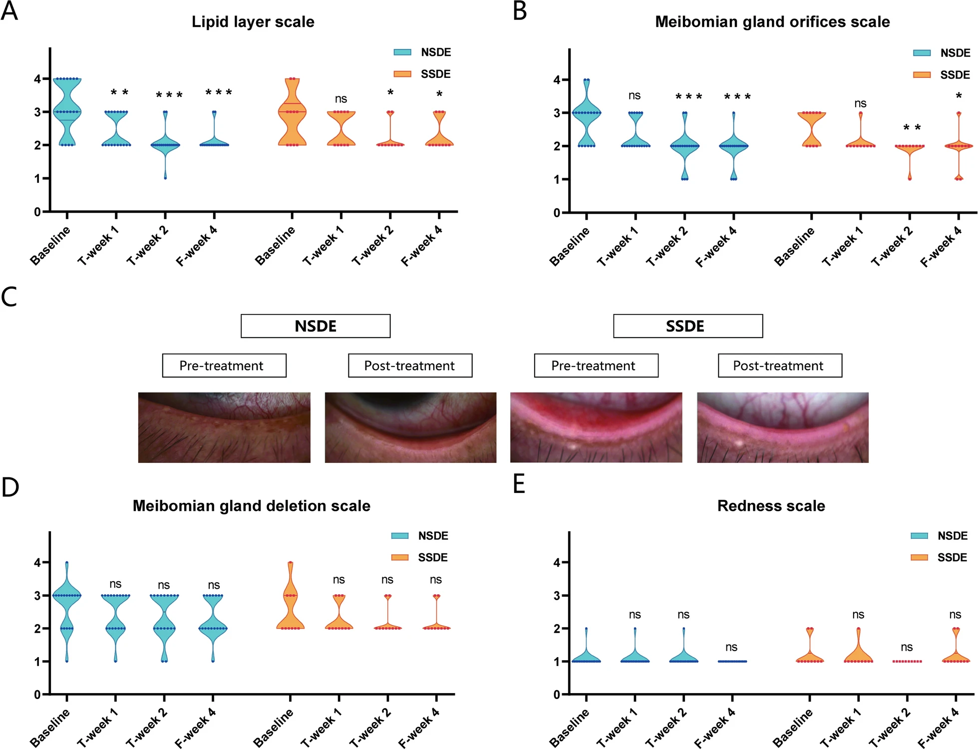 圖3：NSDE和SSDE組基線(xiàn)、T第1周、T第2周和F第4周的脂質(zhì)層、瞼板腺和紅斑量表。