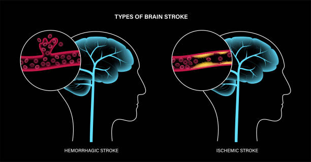從癱瘓到復??！神經(jīng)干細胞療法5大機制如何促進(jìn)中風(fēng)后的大腦修復？