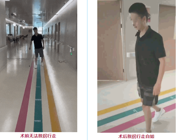 干細胞治療脊髓損傷臨床項目 干細胞治療脊髓損傷臨床項目