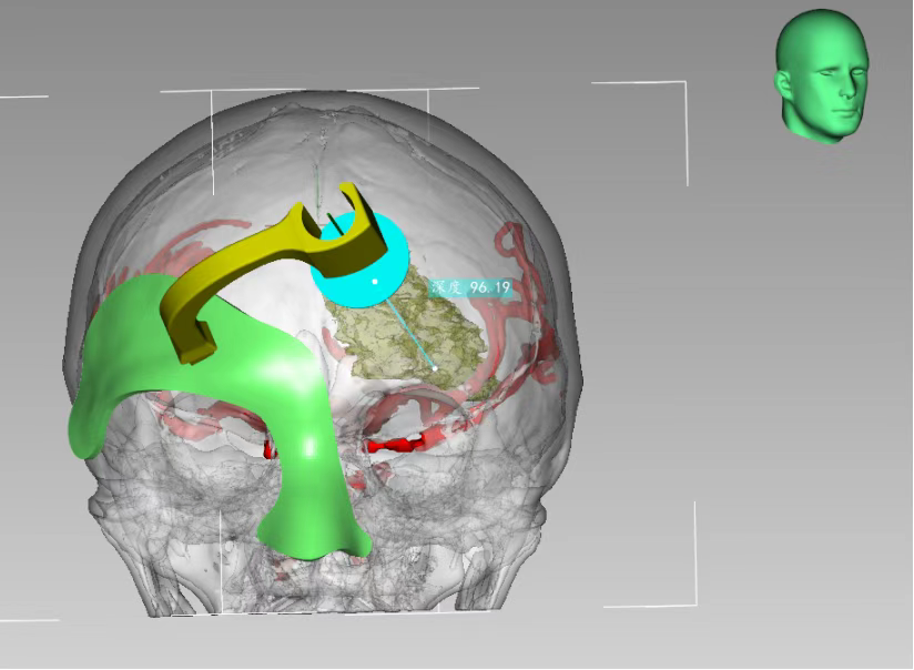 3D打印技術(shù)定位下腦內血腫穿刺術(shù) 3D打印技術(shù)定位下腦內血腫穿刺術(shù)