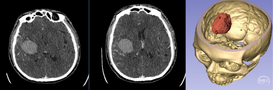 神經(jīng)外科手術(shù)機器人輔助下腦內血腫穿刺術(shù) 神經(jīng)外科手術(shù)機器人輔助下腦內血腫穿刺術(shù)