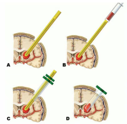 神經(jīng)內鏡輔助下腦內血腫清除術(shù)示意圖 神經(jīng)內鏡輔助下腦內血腫清除術(shù)示意圖