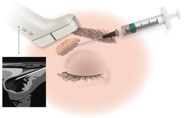 圖1：在超聲引導下向淚腺注射藥物。