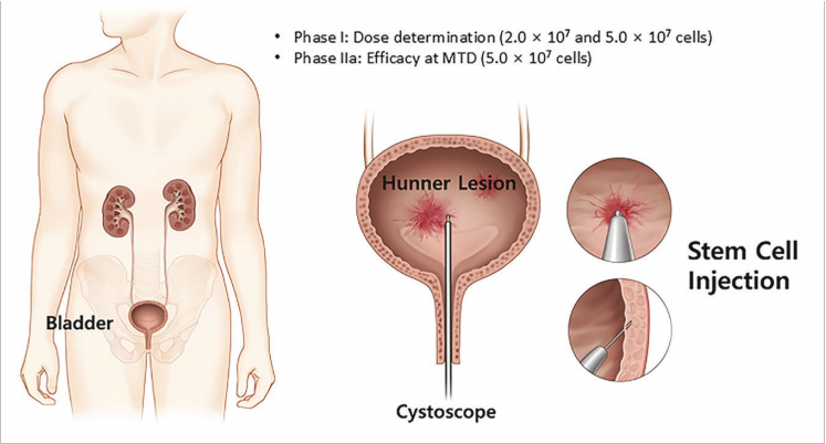 間質(zhì)性膀胱炎臨床試驗 間質(zhì)性膀胱炎臨床試驗