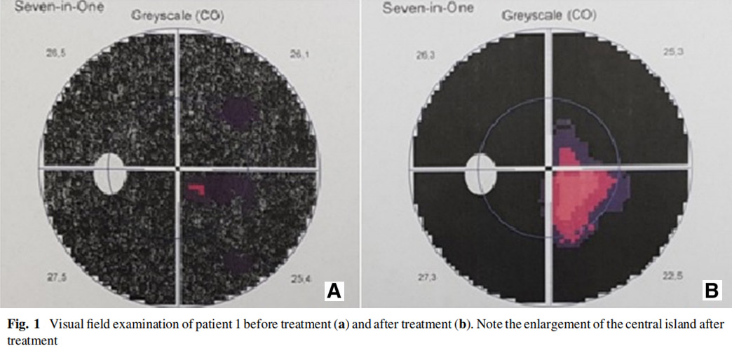 視神經(jīng)萎縮臨床試驗