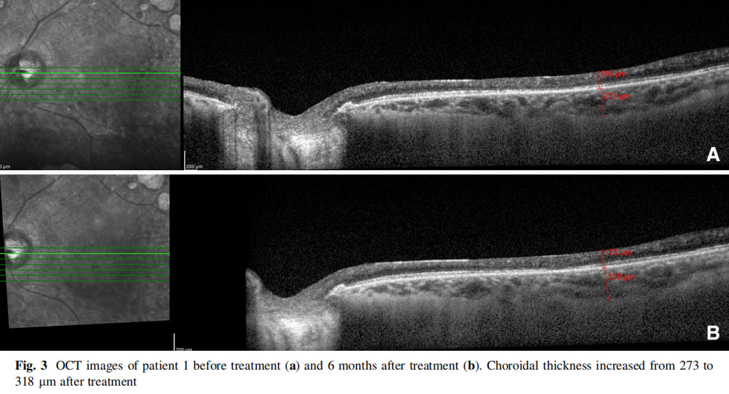 視神經(jīng)萎縮臨床試驗