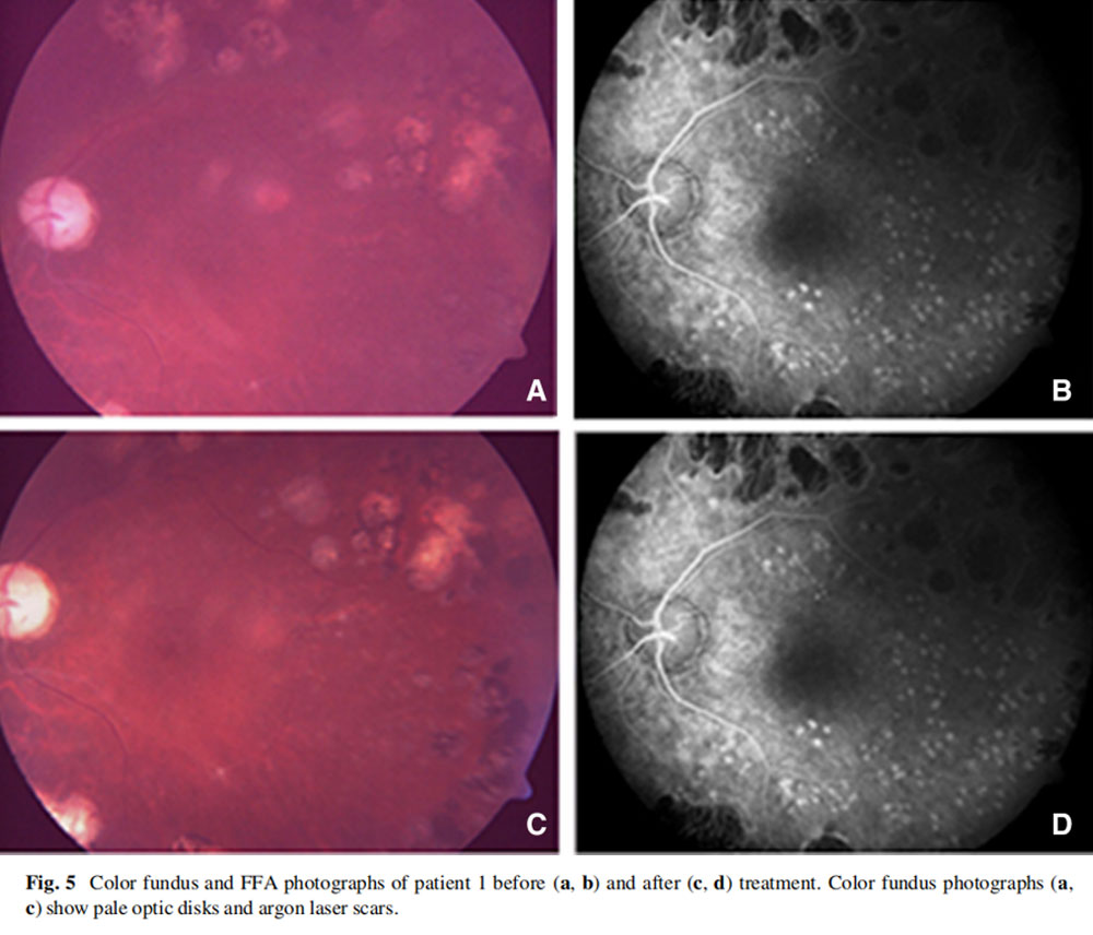 視神經(jīng)萎縮臨床試驗