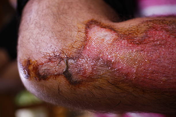 干細胞修復面部深度燒傷：1例患者術(shù)后面部基本恢復正常 | 成功案例