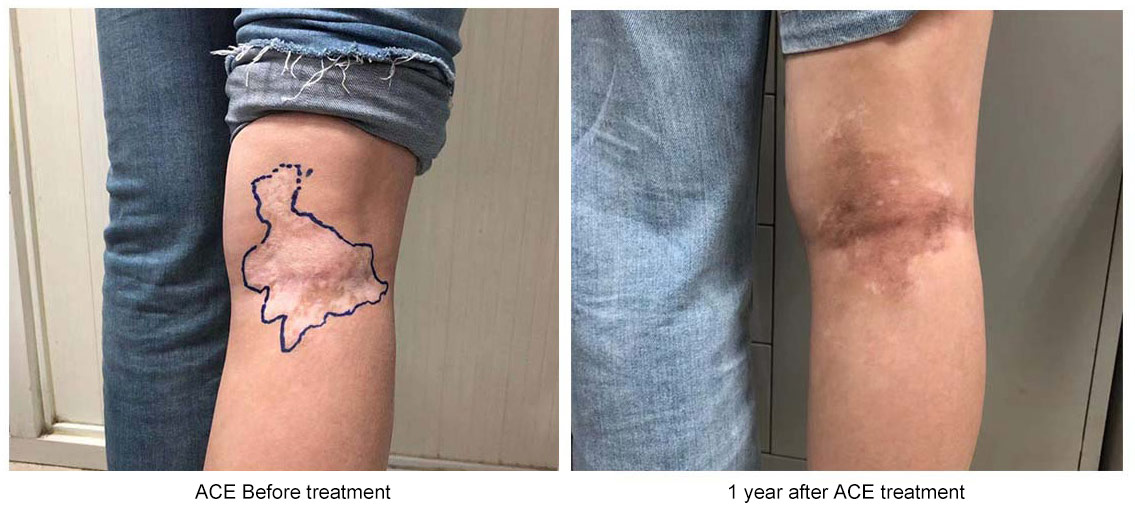 干細胞移植前后白癜風(fēng)癥狀改變